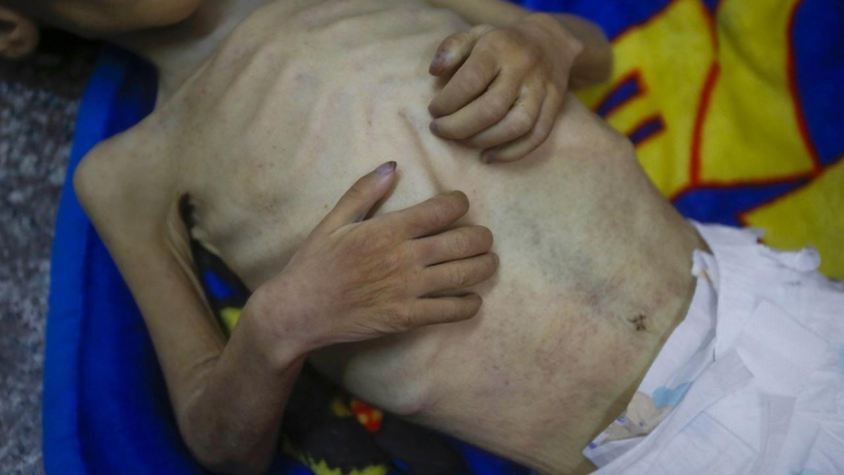 Gazze’de açlıktan ölenlerin sayısı artıyor